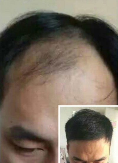 安阳卫他委批准的移植头发机构