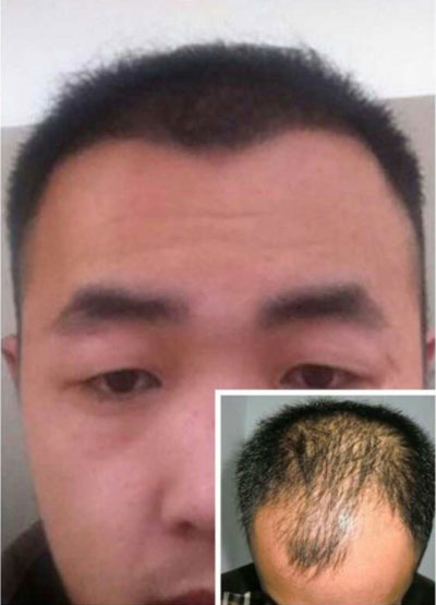 焦作毛发增多技术