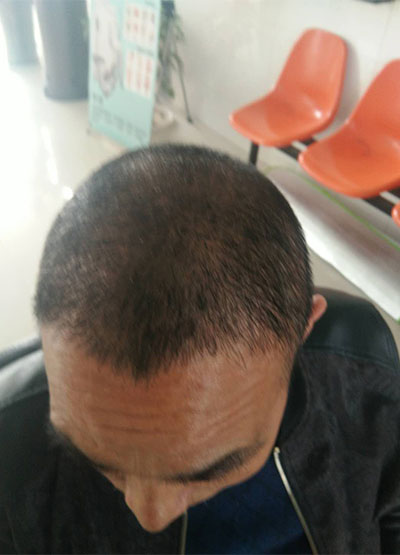 新乡市植发专家郜义祥