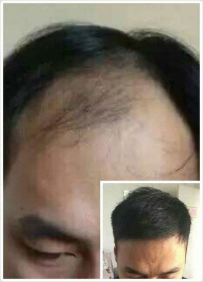 安阳新乡市头发问题找谁治疗