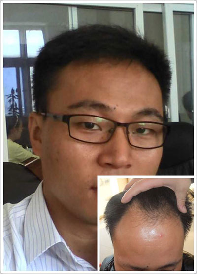 焦作新乡市无痛苦植发