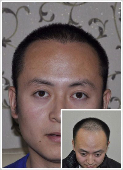 焦作植发痛苦吗