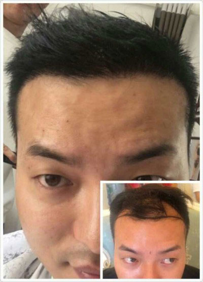 安阳新乡市种植头发的机构