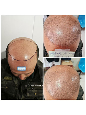 焦作新乡市四区八县哪里有植发