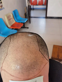 焦作家族式种植头发团队