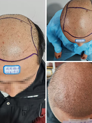 新乡市植发哪家好