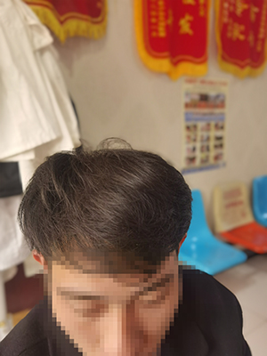 新乡市微针种植头发