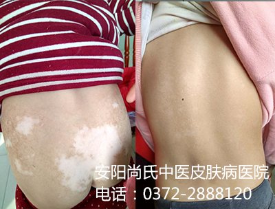 白癜风患者对比