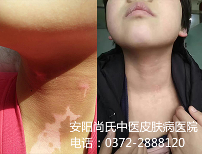 白癜风患者对比