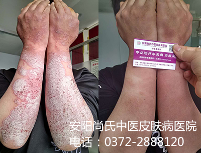 中医牛皮癣治疗