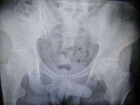 股骨头坏死怎么办