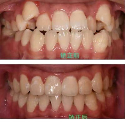 儿童牙齿正畸专科