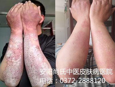 牛皮癣患者对比