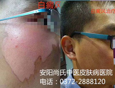 白癜风患者对比