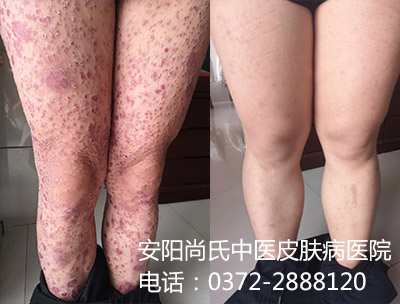 中医牛皮癣治疗