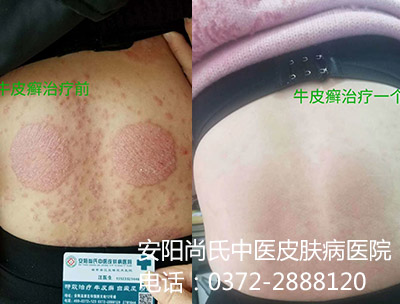 牛皮癣患者对比