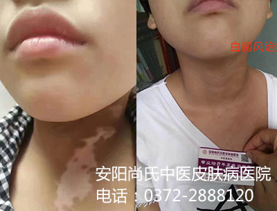 白癜风疗效好