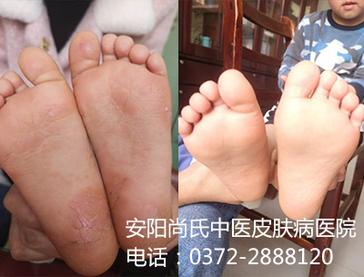 牛皮癣患者对比