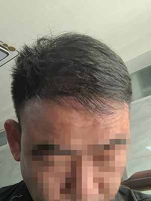郑州栽头发多少钱？