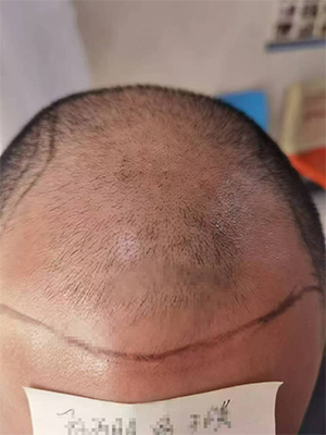 郑州种植头发