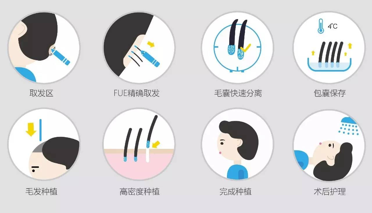 无痕毛囊移植
