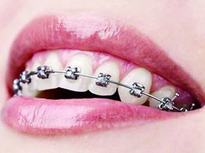 成人牙齿矫正专科