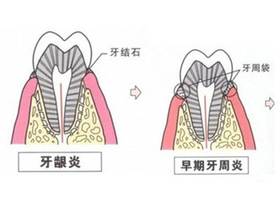 治疗牙周专科