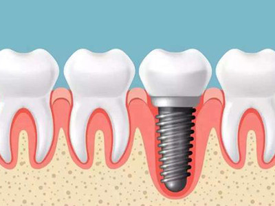 专业牙齿种植专科