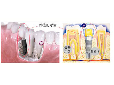 微创无疼种植牙