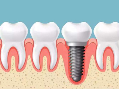 成人种植单牙专科