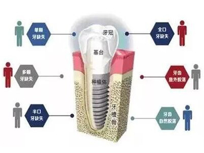 牙齿种植专科