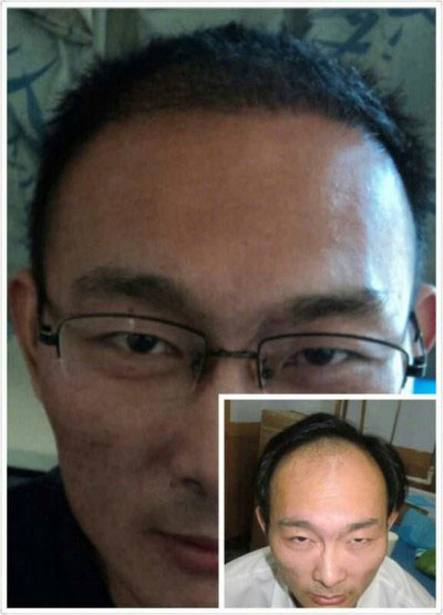护发植发